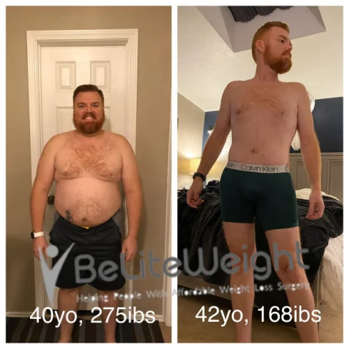 Weight Loss Surgery Gastric Sleeve before and after Mikel M - 4 Year Update*